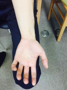 無理にまっすぐにしてもらうと、指先が全部曲がってしまいます。大作業ですが、手首の状態を少しでも改善しないと手を痛めてしまう可能性が高いと判断しました